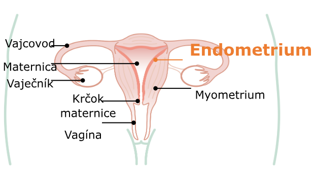 endometrioza